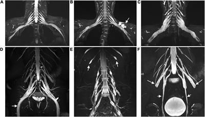 Multisequence Quantitative Magnetic Resonance Neurography of Brachial and Lumbosacral Plexus in Chronic Inflammatory Demyelinating Polyneuropathy